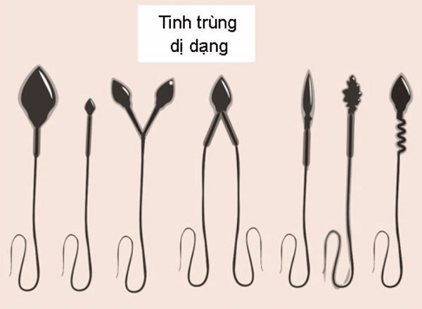 Dị dạng về hình thể tinh trùng