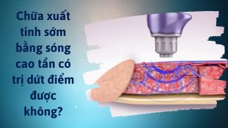 Chữa xuất tinh sớm bằng sóng cao tần
