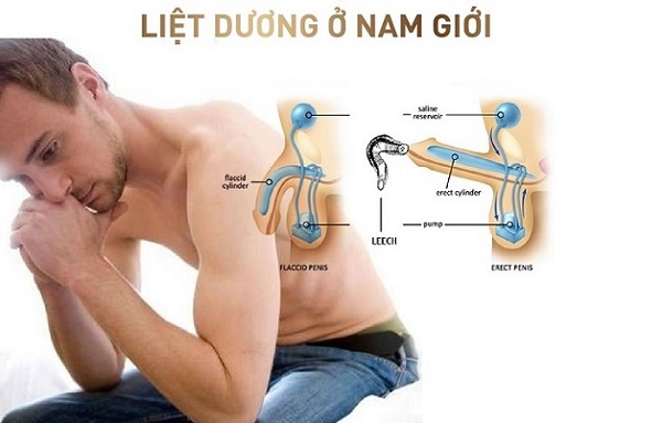 Liệt dương ở nam giới