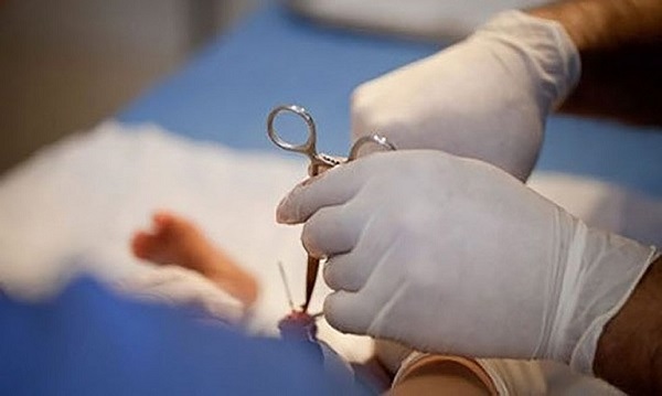 nam giới cắt bao quy đầu bị xuất tinh sớm