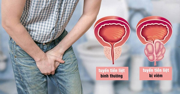 Bệnh tuyến tiền liệt