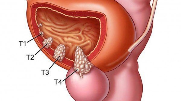 Cách phát hiện ung thư tiền liệt tuyến