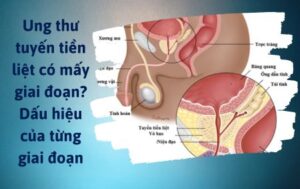 ung thư tuyến tiền liệt có mấy giai đoạn