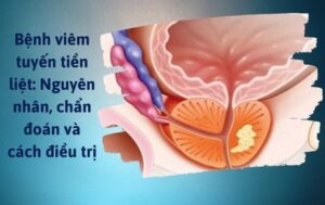 Viêm tuyến tiền liệt