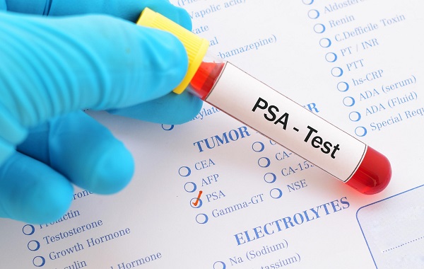 Xét nghiệm PSA phát hiện ung thư tuyến tiền liệt