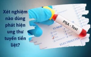 Xét nghiệm ung thư tuyến tiền liệt