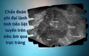 chuẩn đoán phì đại tuyến tiền liệt